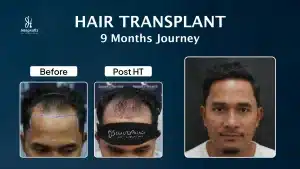 Tanta Ginting Hair Transplant Indonesia oleh Integrafts setelah 9 bulan