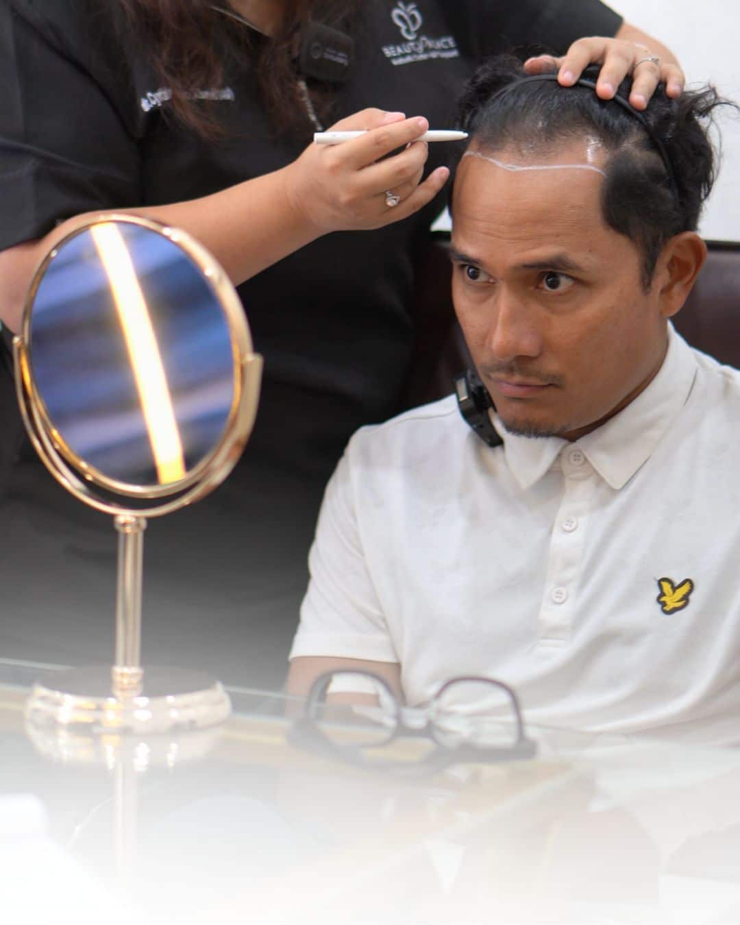 Mengukur dan menandai area yang akan ditransplantasi rambut di Integrafts