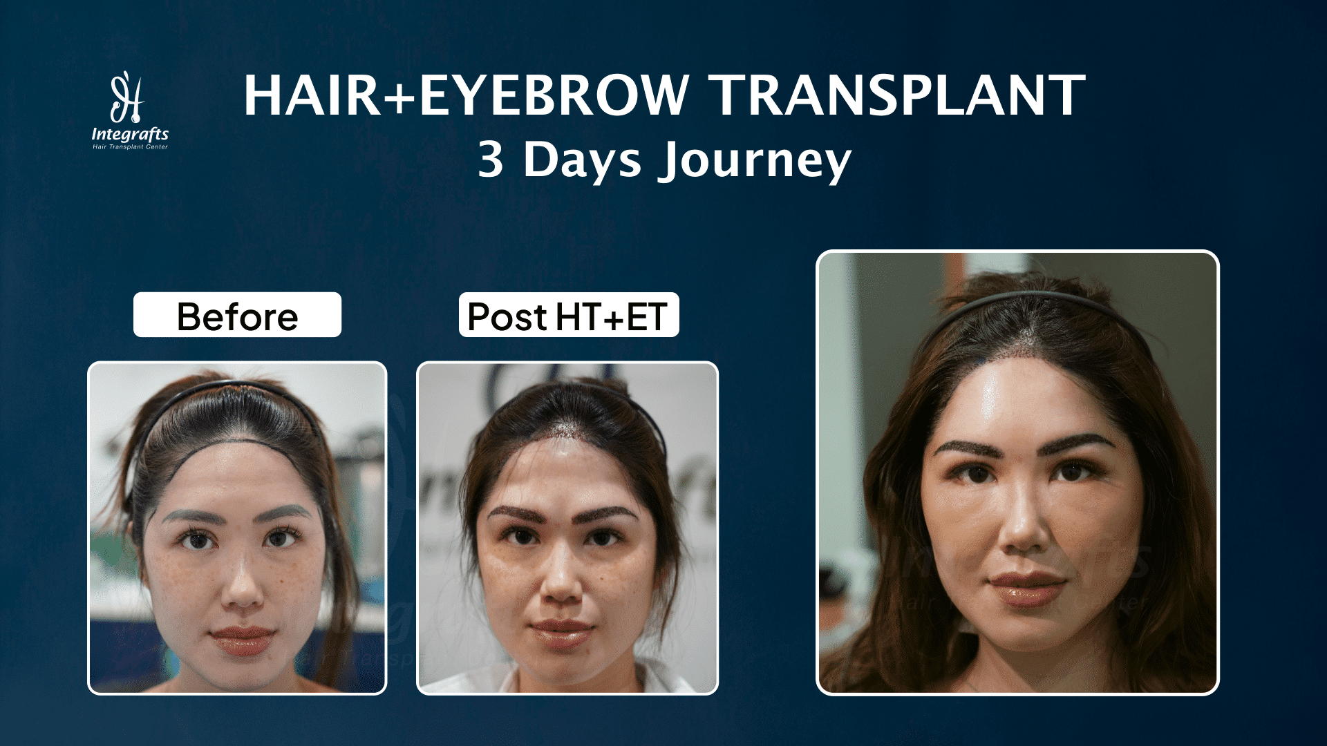 Eyebrow Transplant Result after 3 Days