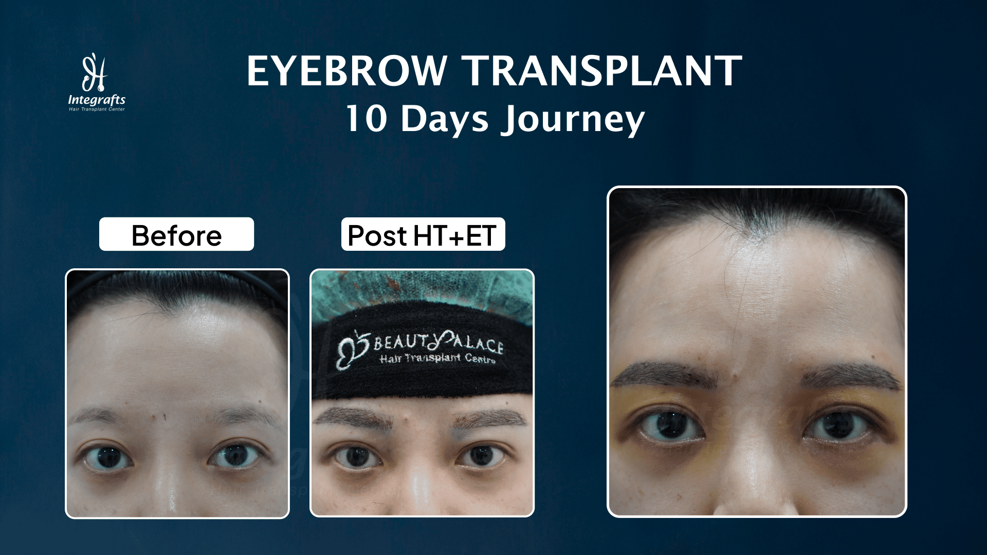Eyebrow Transplant Result after 10 Days