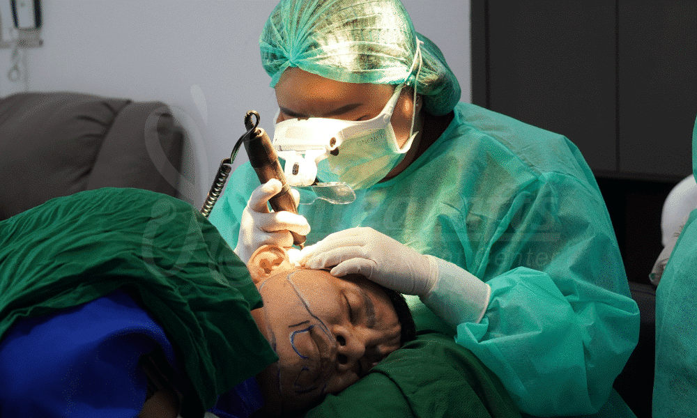Proses Transplantasi Jenggot