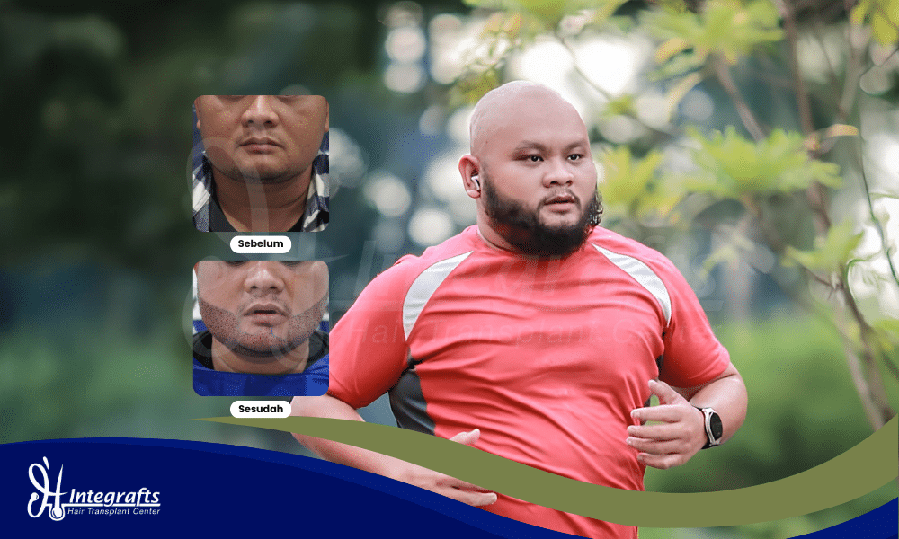 Sudah Coba Minoxidil tapi Jenggot Masih Botak Ini Solusi Medis yang Beneran Ampuh