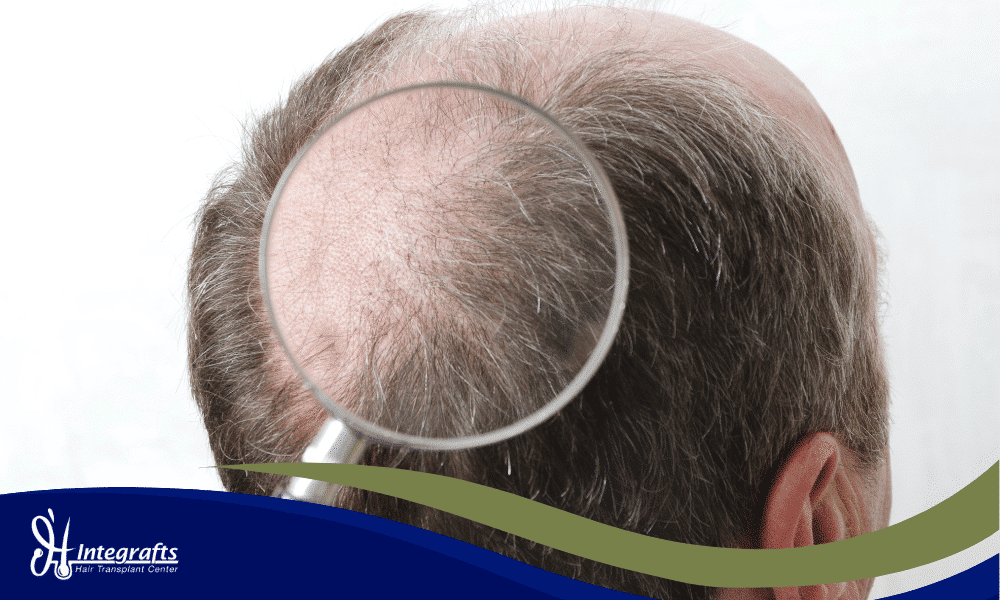 6 Syarat Transplantasi Rambut yang Harus Kamu Penuhi Sebelum Operasi