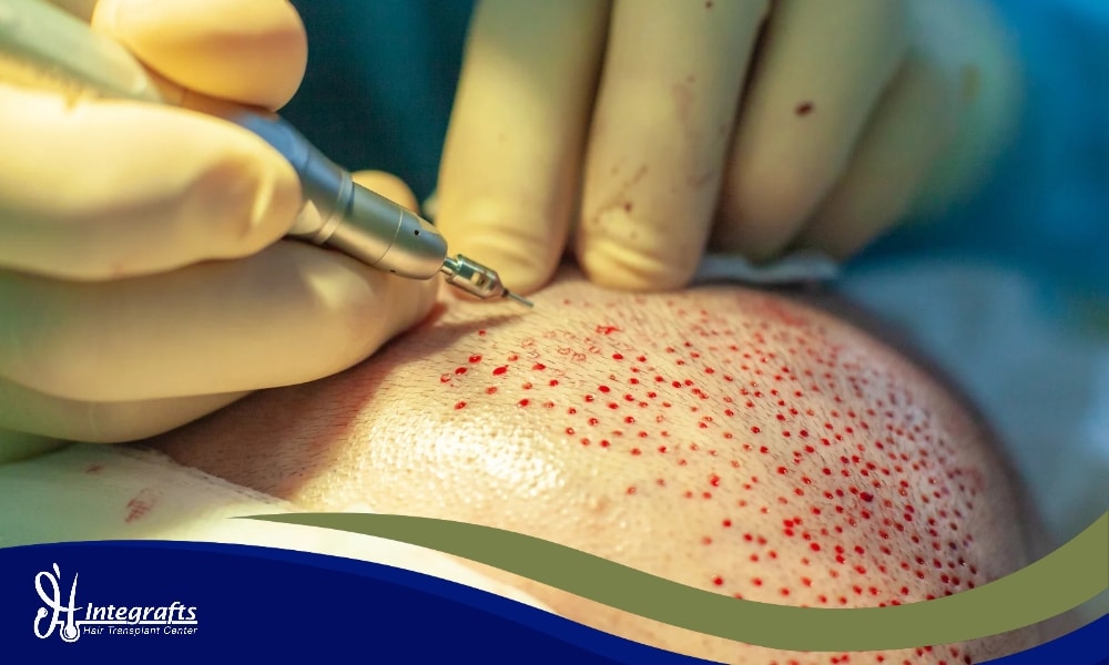 Body Hair Transplant (BHT): Solusi Terakhir Saat Stok Rambut di Kepala Sudah Habis