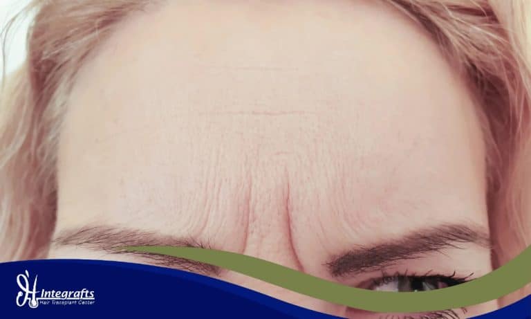 Punya Jidat Jenong (Lebar)? Ini Cara Mengecilkannya Secara Permanen Tanpa Operasi Plastik Potong Kulit