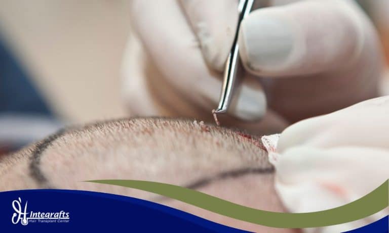 FUE vs DHI: Mana yang Lebih Bagus? Di Integrafts, Anda Dapat Keduanya!