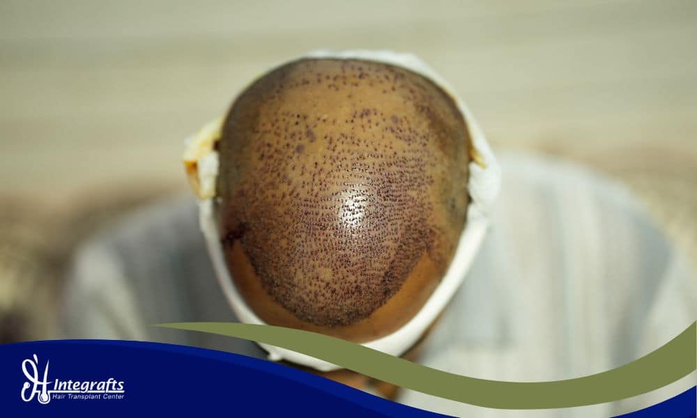 Hair Transplant Gagal Jangan Panik, Ini Solusi Repair untuk Memperbaiki Hasil yang Tidak Natural