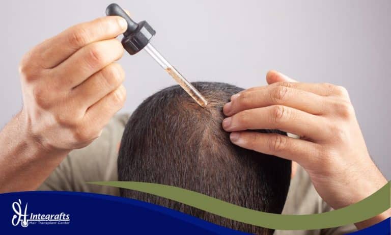 Minoxidil vs Hair Transplant: Mana Solusi Terbaik untuk Masalah Kebotakan Anda?