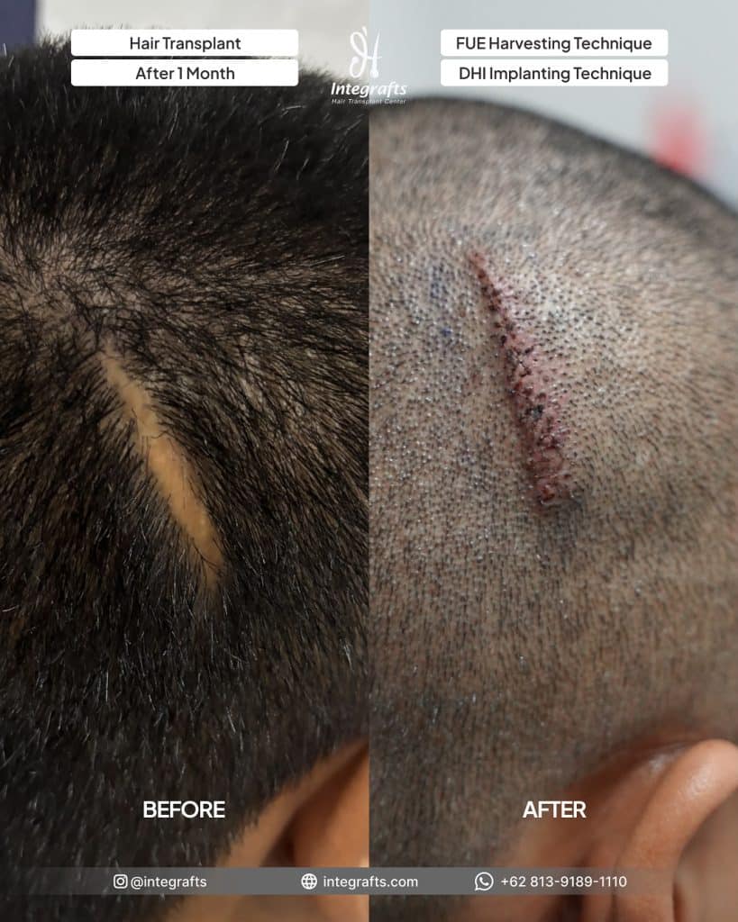Bisakah Tanam Rambut di Atas Bekas Luka & Jahitan? Ini Fakta Medisnya 1 Transplantasi Rambut Area Luka atau Pitak