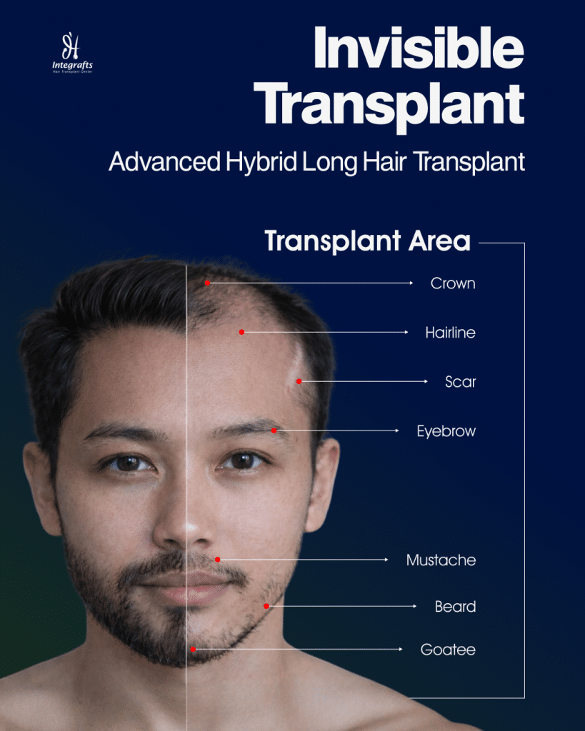 Gambar ini adalah visualisasi area yang dapat dilakukan long hair transplant oleh Integrafts. Area ini berada di kepala, mulai dari area crown/ubun-ubun, hairline/garis rambut, scar/bekas luka, eyebrow/alis, mustache/kumis, beard/jambang/brewok, goatee/janggut